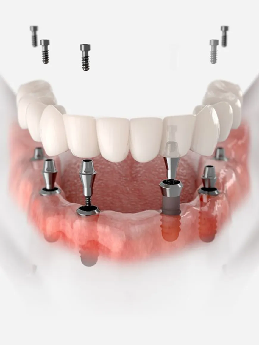 Trồng răng toàn hàm